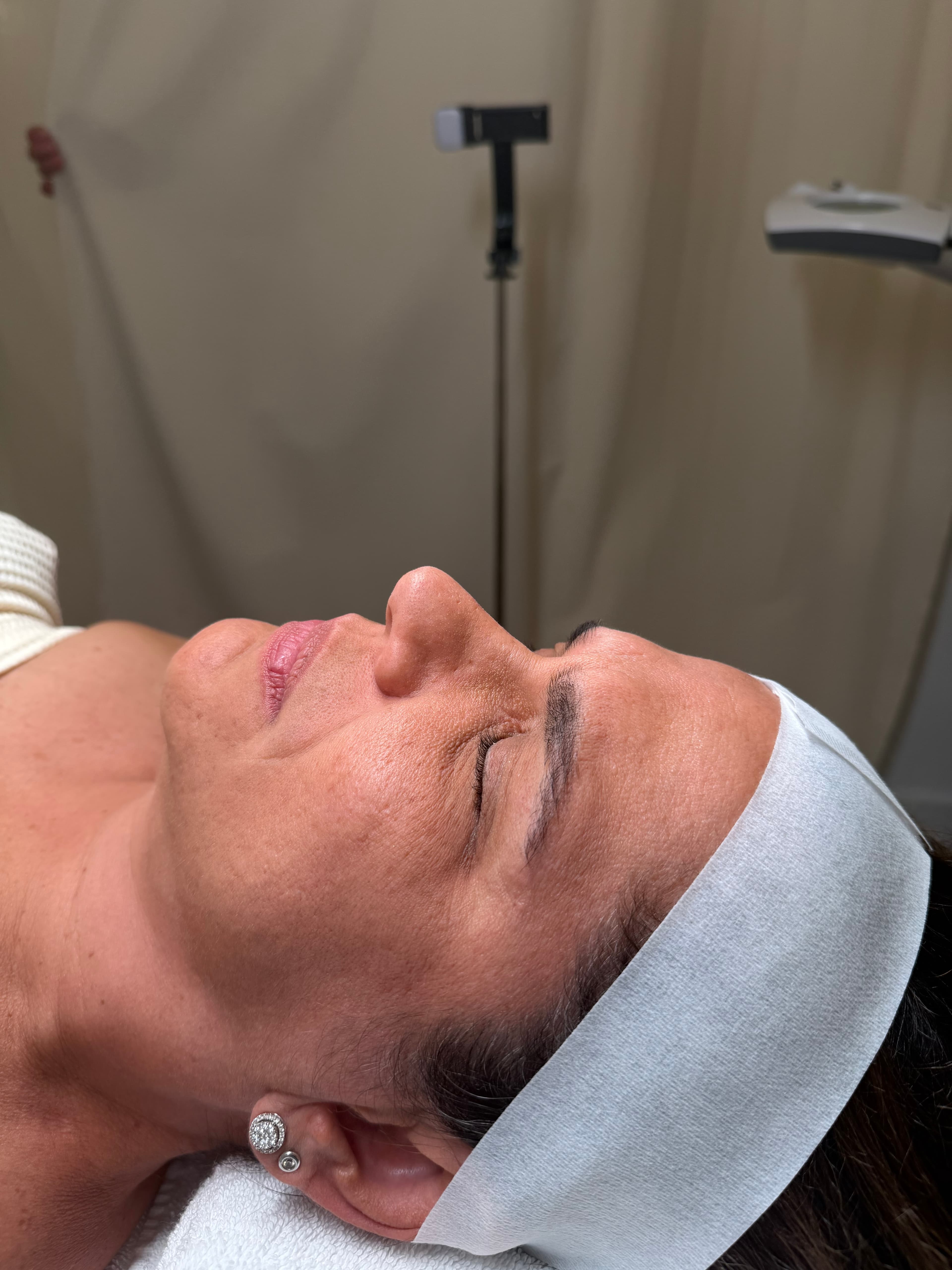 Claudia, 60 before Custom Skin Treatment