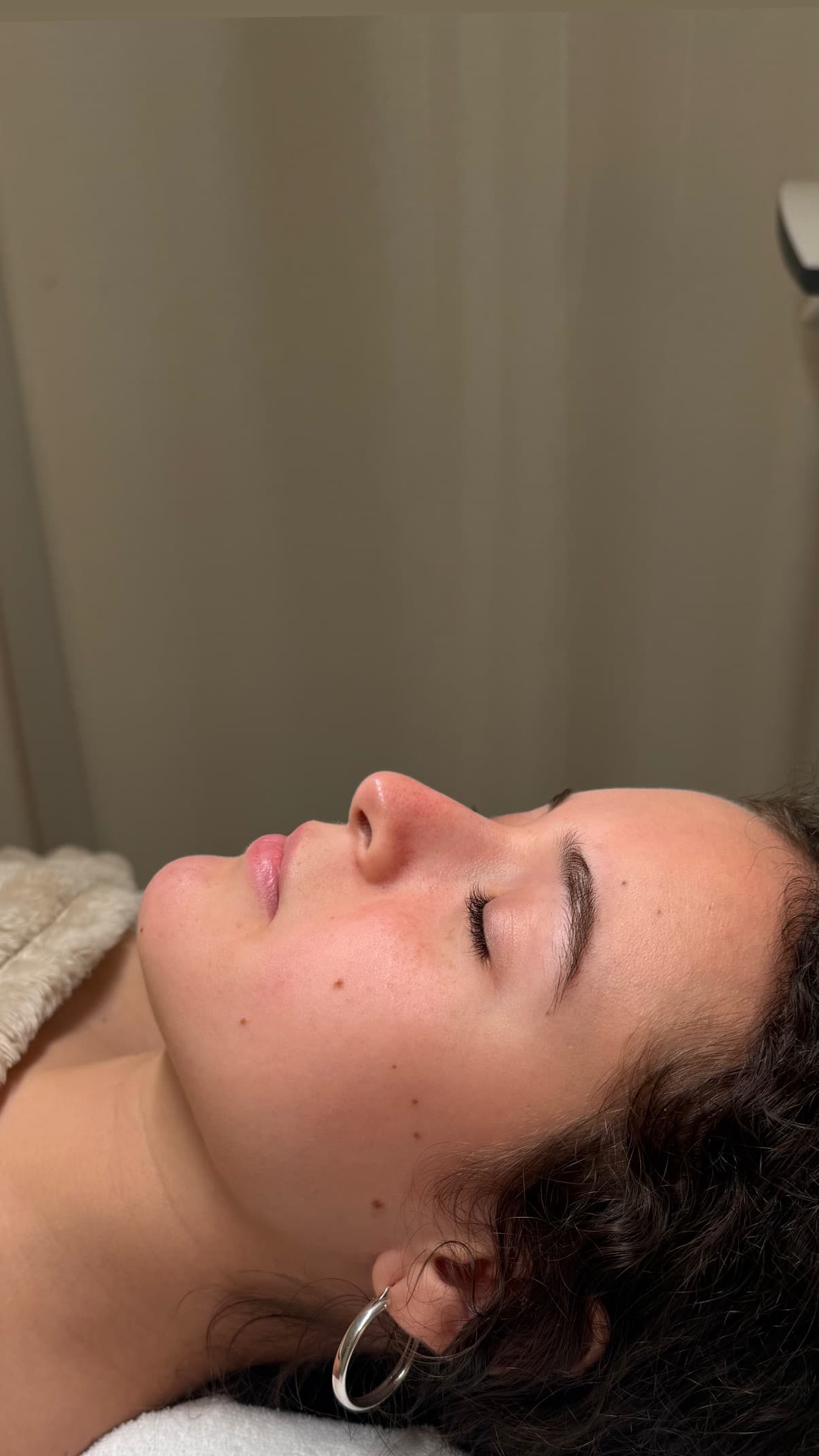 Rania, 21 before Custom Skin Treatment